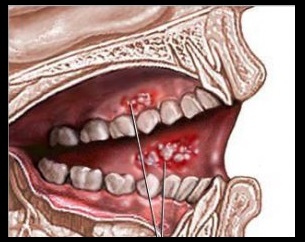 dental-implants-irving